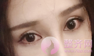 长沙全切双眼皮术后78天日记