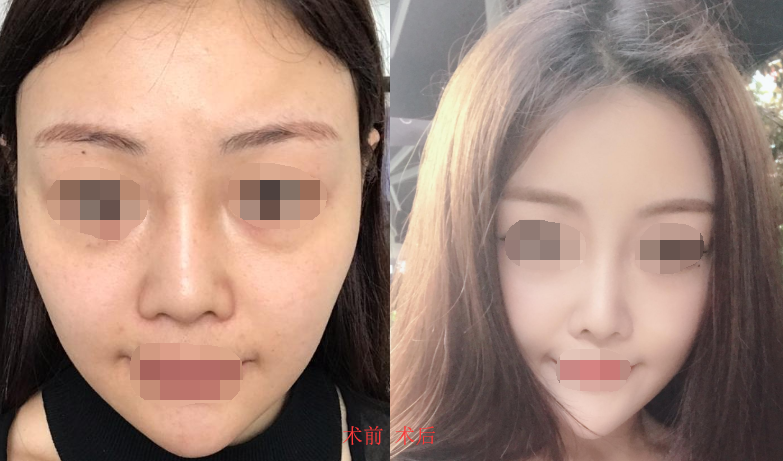重庆脂肪填充全脸案例,自体脂肪的作用