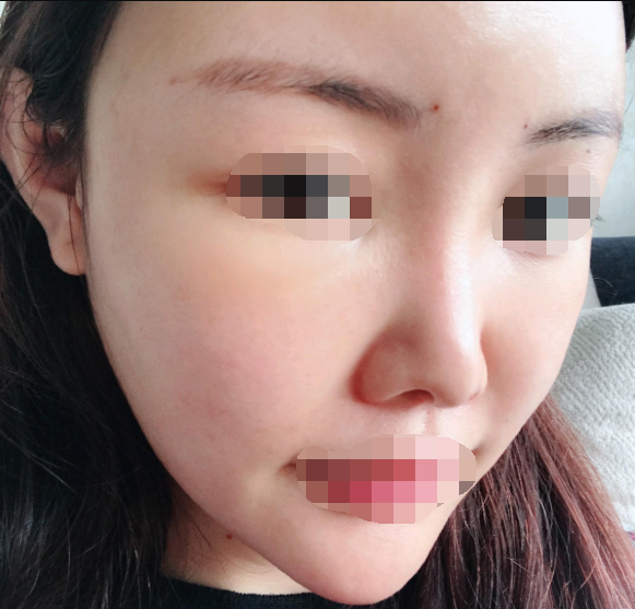 重庆脂肪填充全脸案例,自体脂肪的作用