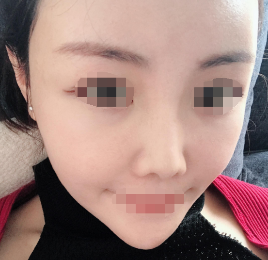 重庆脂肪填充全脸案例,自体脂肪的作用