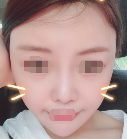 重庆脂肪填充全脸案例,自体脂肪的作用