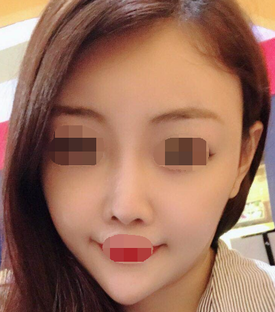 重庆脂肪填充全脸案例,自体脂肪的作用