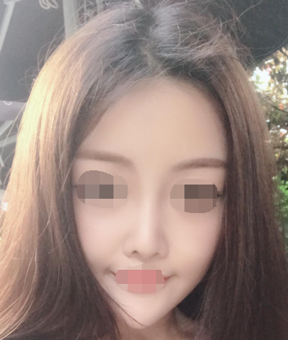重庆脂肪填充全脸案例,自体脂肪的作用