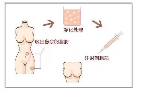假体隆胸 OR 自体脂肪隆胸?