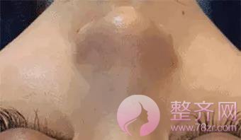 夏季打玻尿酸,会融化吗?