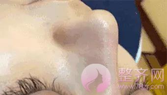 夏季打玻尿酸,会融化吗?