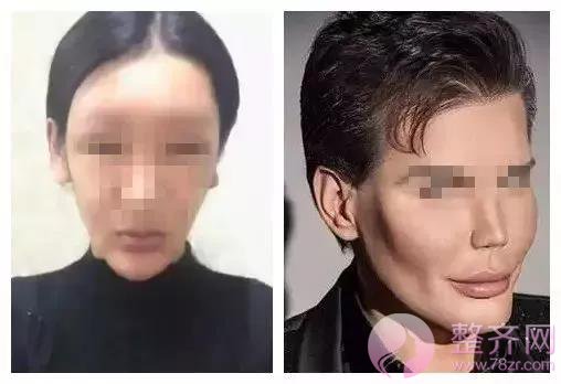 夏季打玻尿酸,会融化吗?