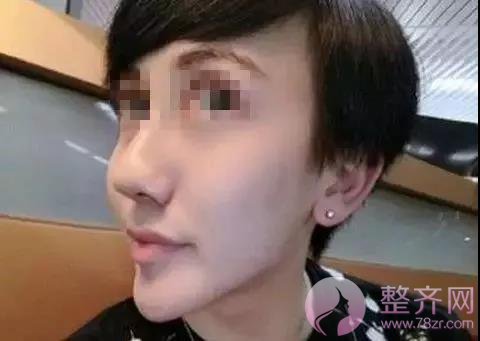 夏季打玻尿酸,会融化吗?