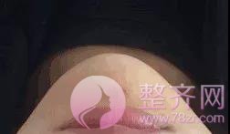 夏季打玻尿酸,会融化吗?