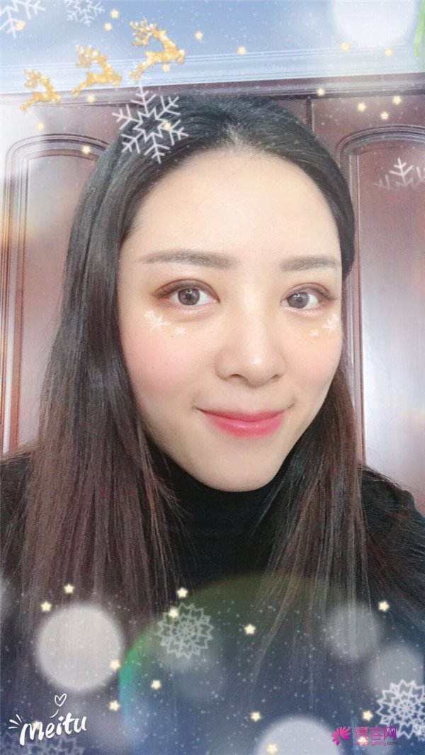 广州埋线双眼皮医院案例术后反馈分享,果怎么样?价格多少钱?一看便知!