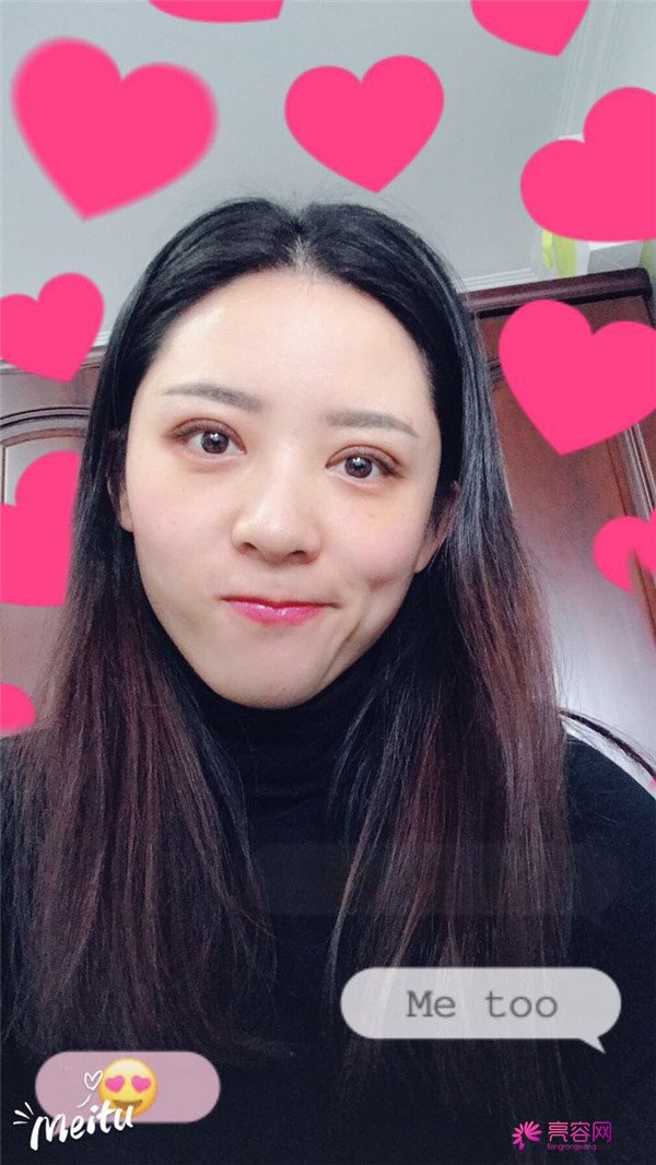 广州埋线双眼皮医院案例术后反馈分享,果怎么样?价格多少钱?一看便知!