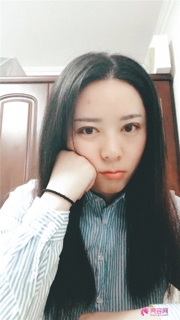 广州埋线双眼皮医院案例术后反馈分享,果怎么样?价格多少钱?一看便知!