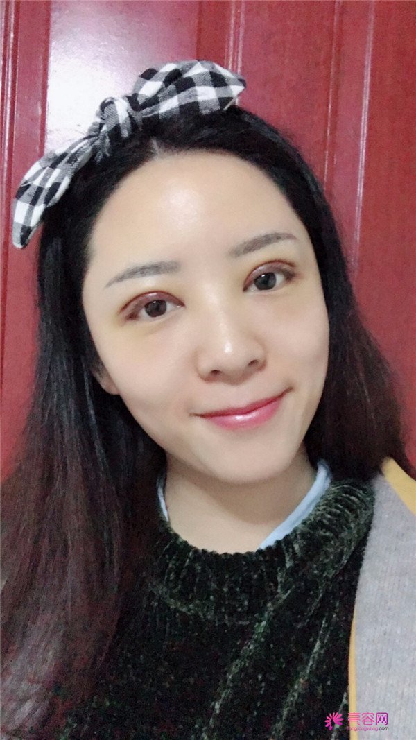 广州埋线双眼皮医院案例术后反馈分享,果怎么样?价格多少钱?一看便知!