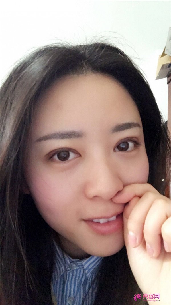 广州埋线双眼皮医院案例术后反馈分享,果怎么样?价格多少钱?一看便知!