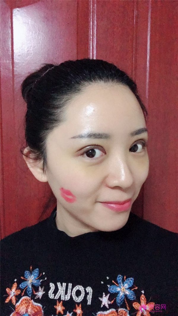 广州埋线双眼皮医院案例术后反馈分享,果怎么样?价格多少钱?一看便知!