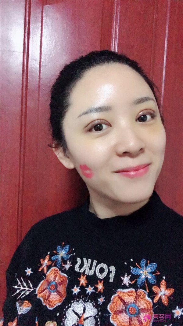 广州埋线双眼皮医院案例术后反馈分享,果怎么样?价格多少钱?一看便知!