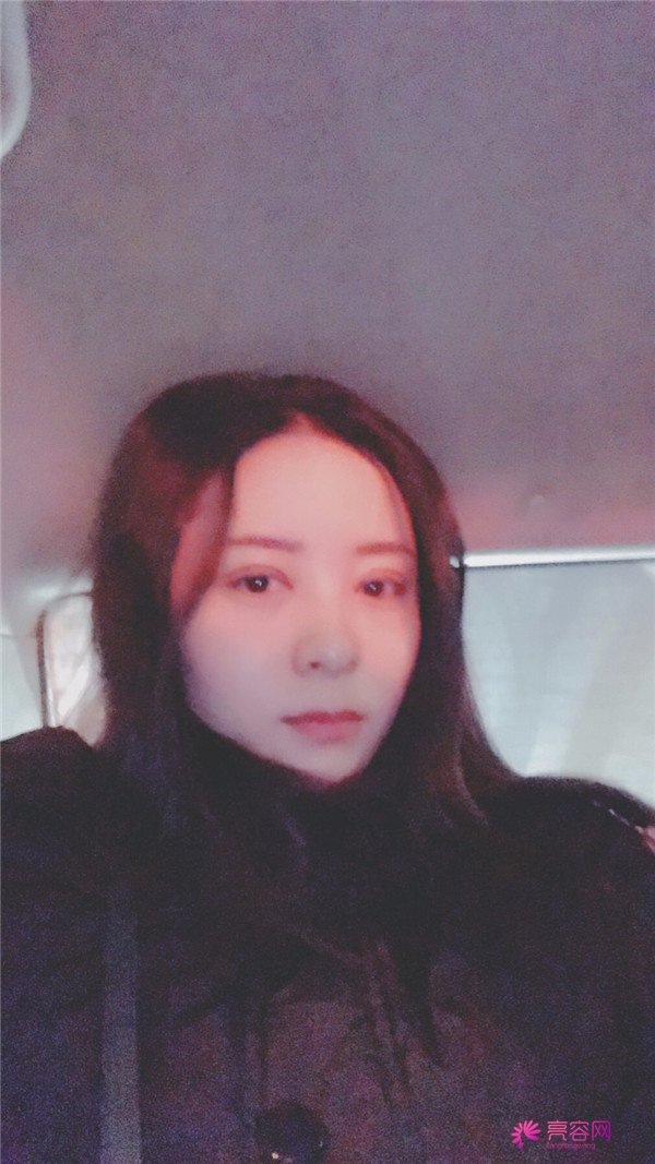 广州埋线双眼皮医院案例术后反馈分享,果怎么样?价格多少钱?一看便知!
