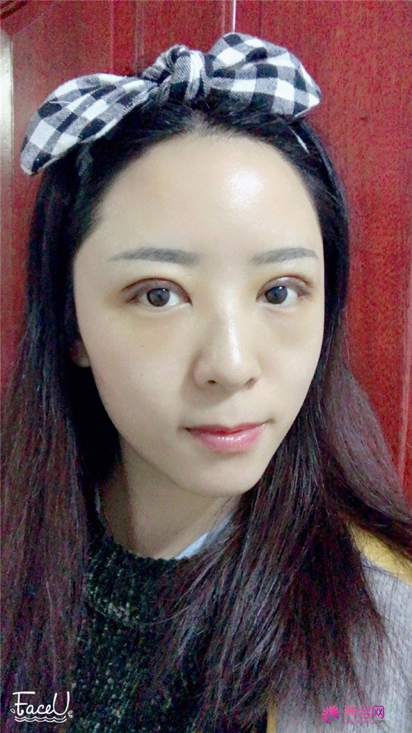 广州埋线双眼皮医院案例术后反馈分享,果怎么样?价格多少钱?一看便知!