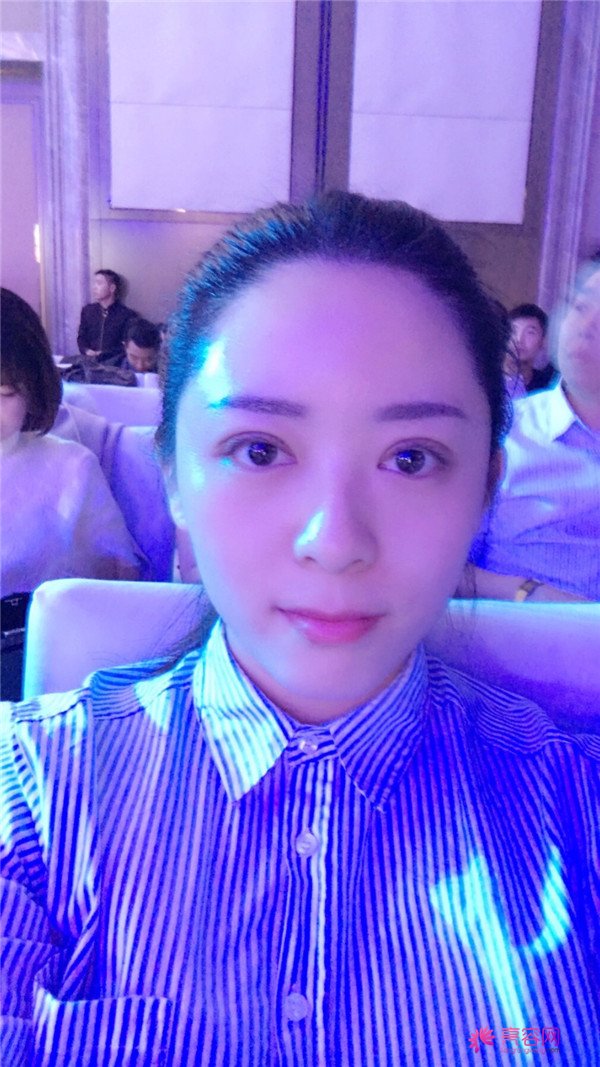 广州埋线双眼皮医院案例术后反馈分享,果怎么样?价格多少钱?一看便知!