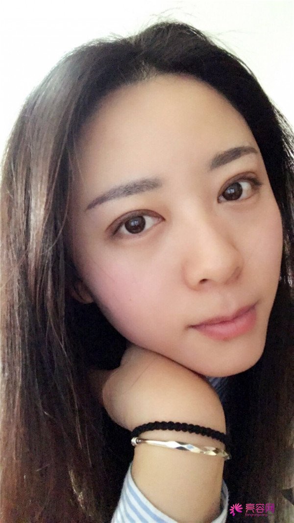 广州埋线双眼皮医院案例术后反馈分享,果怎么样?价格多少钱?一看便知!