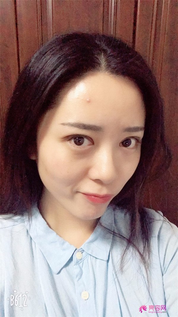 广州埋线双眼皮医院案例术后反馈分享,果怎么样?价格多少钱?一看便知!