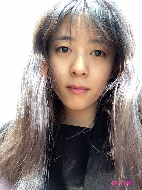 广州埋线双眼皮医院案例术后反馈分享,果怎么样?价格多少钱?一看便知!