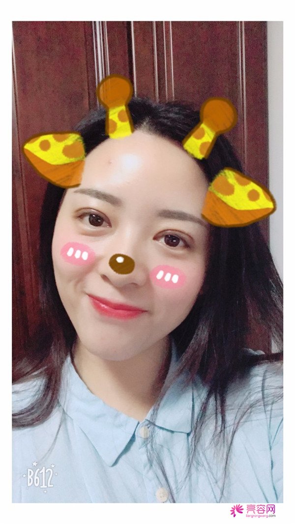 广州埋线双眼皮医院案例术后反馈分享,果怎么样?价格多少钱?一看便知!