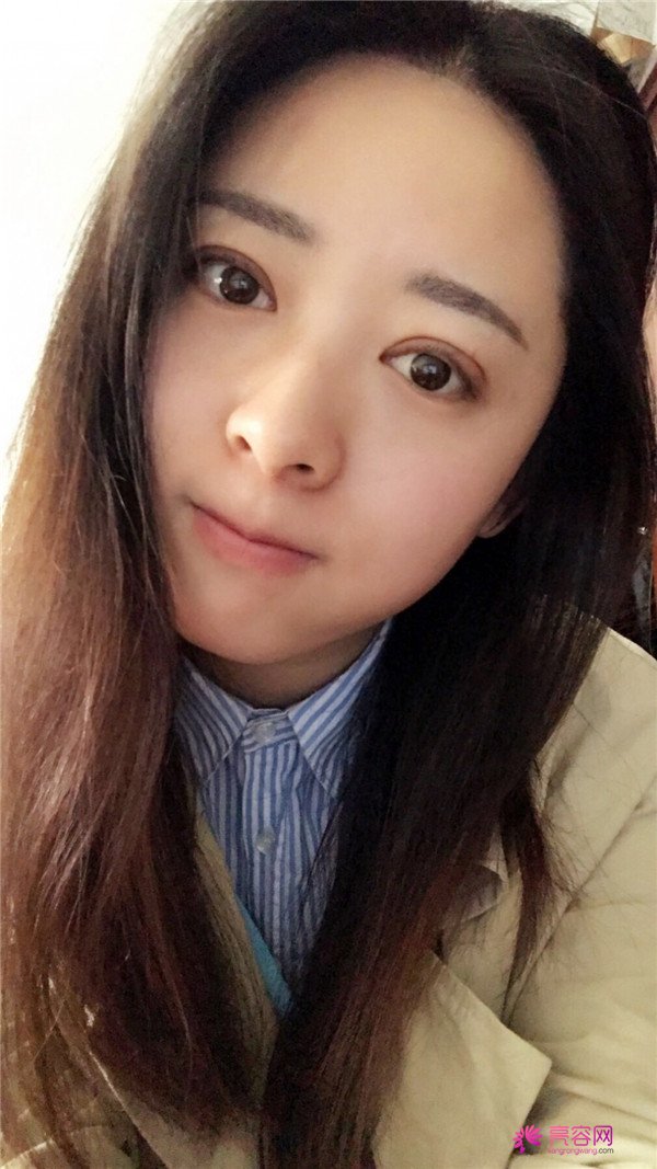 广州埋线双眼皮医院案例术后反馈分享,果怎么样?价格多少钱?一看便知!