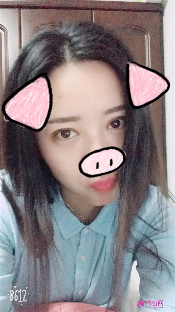 广州埋线双眼皮医院案例术后反馈分享,果怎么样?价格多少钱?一看便知!