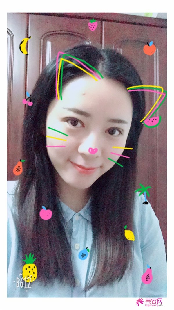 广州埋线双眼皮医院案例术后反馈分享,果怎么样?价格多少钱?一看便知!