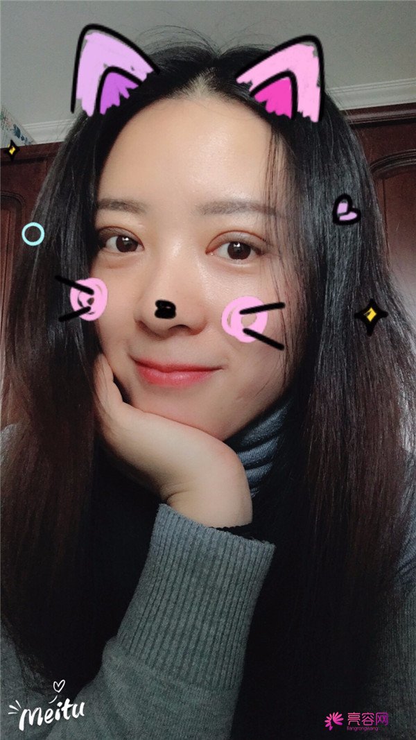 广州埋线双眼皮医院案例术后反馈分享,果怎么样?价格多少钱?一看便知!