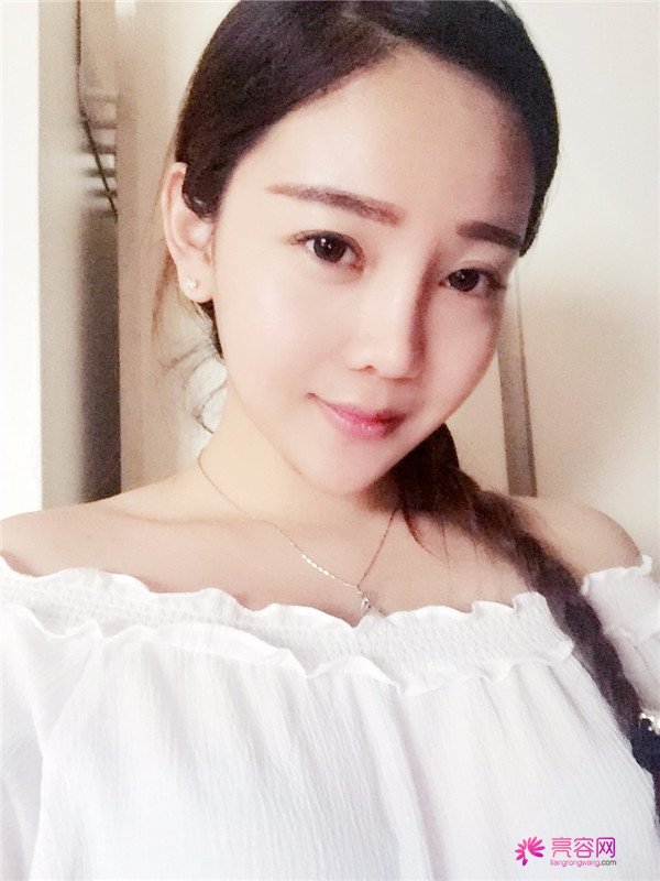 北京自体脂肪填充医院案例术后反馈分享,果怎么样?价格多少钱?一看便知!