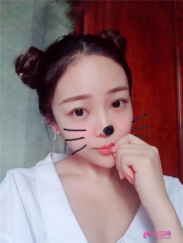 北京自体脂肪填充医院案例术后反馈分享,果怎么样?价格多少钱?一看便知!