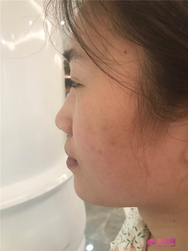 福建膨体隆鼻医院案例术后反馈分享,果怎么样?价格多少钱?一看便知!