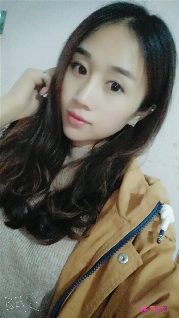 福建膨体隆鼻医院案例术后反馈分享,果怎么样?价格多少钱?一看便知!