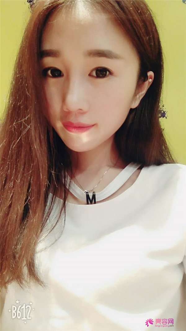 福建膨体隆鼻医院案例术后反馈分享,果怎么样?价格多少钱?一看便知!