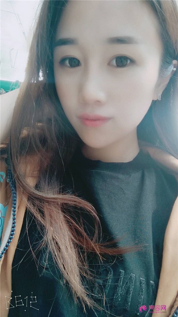 福建膨体隆鼻医院案例术后反馈分享,果怎么样?价格多少钱?一看便知!