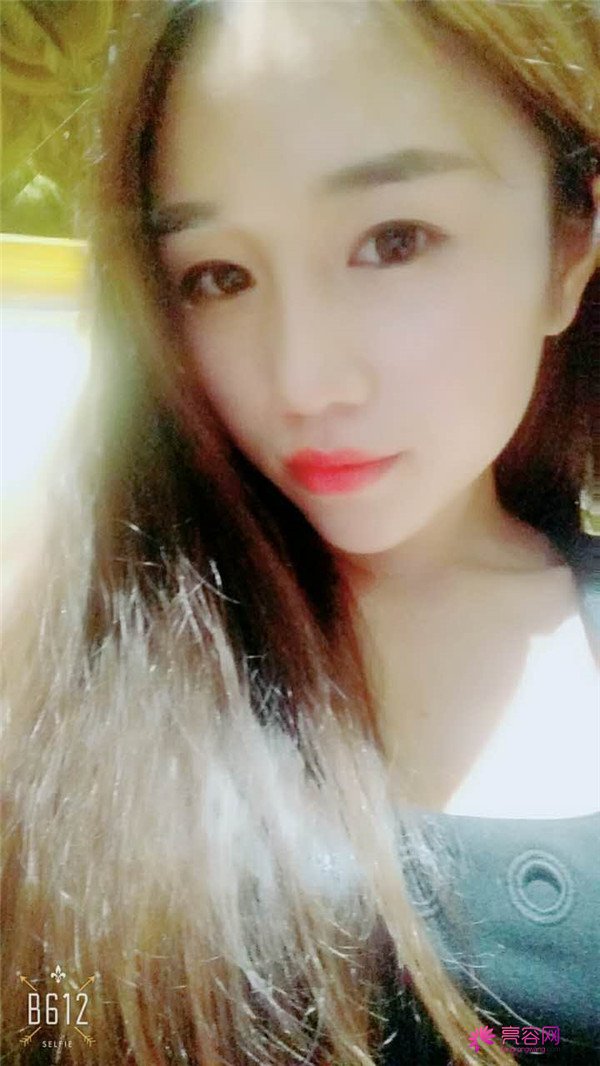 福建膨体隆鼻医院案例术后反馈分享,果怎么样?价格多少钱?一看便知!