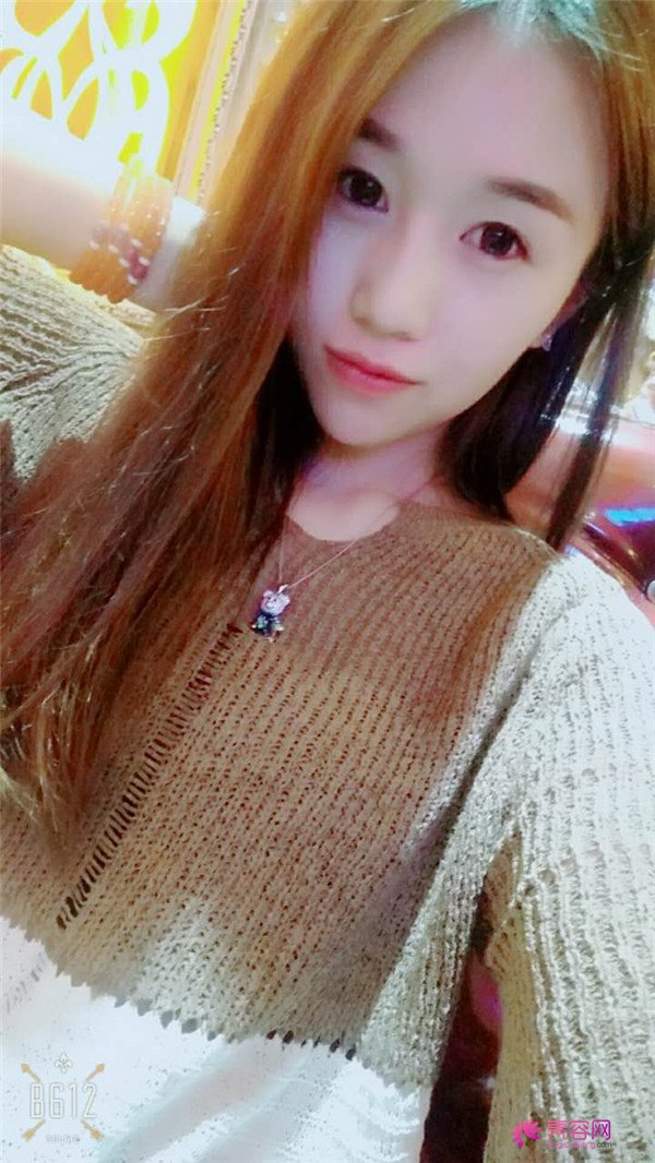 福建膨体隆鼻医院案例术后反馈分享,果怎么样?价格多少钱?一看便知!