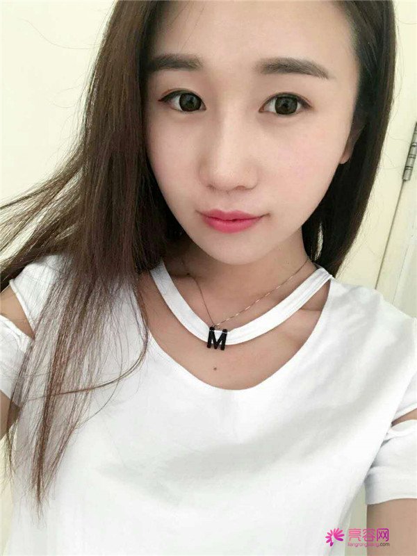 福建膨体隆鼻医院案例术后反馈分享,果怎么样?价格多少钱?一看便知!