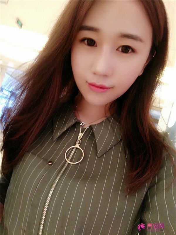 福建膨体隆鼻医院案例术后反馈分享,果怎么样?价格多少钱?一看便知!