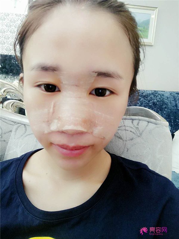 福建膨体隆鼻医院案例术后反馈分享,果怎么样?价格多少钱?一看便知!