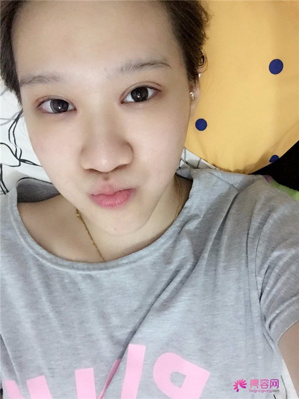 宝宝们,大家好,我来啦~我做的是眼部手术,恢复的很好哦,进来看看我的经历吧!