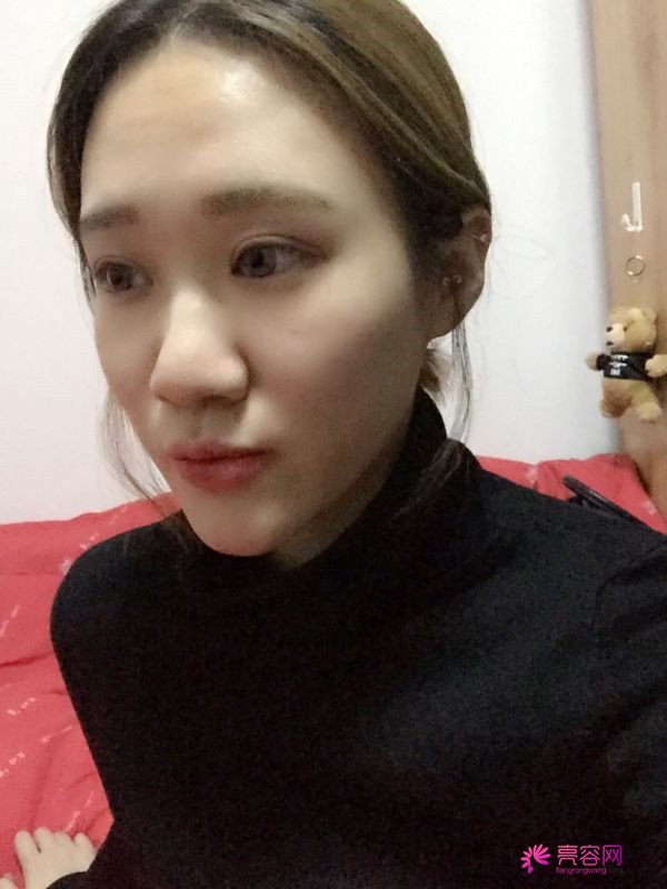 宝宝们,大家好,我来啦~我做的是眼部手术,恢复的很好哦,进来看看我的经历吧!