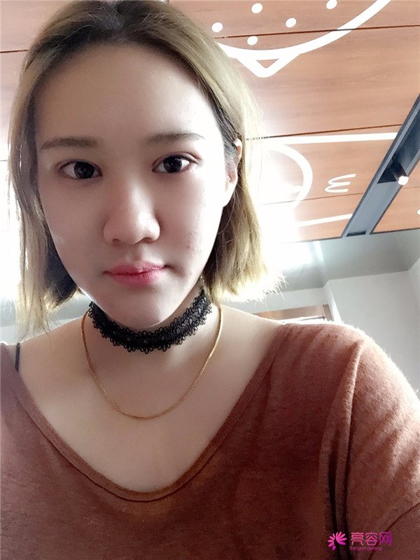 宝宝们,大家好,我来啦~我做的是眼部手术,恢复的很好哦,进来看看我的经历吧!