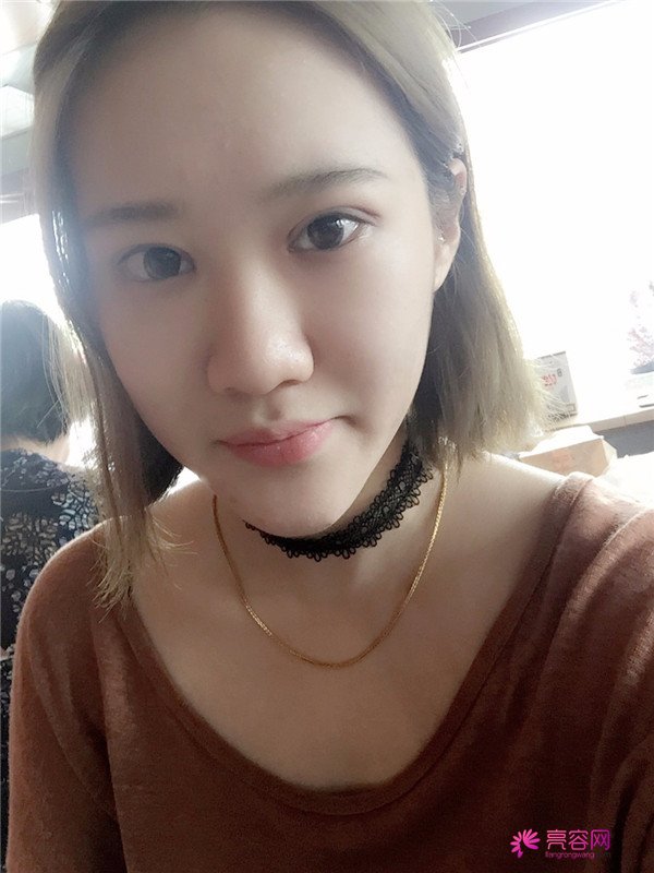 宝宝们,大家好,我来啦~我做的是眼部手术,恢复的很好哦,进来看看我的经历吧!