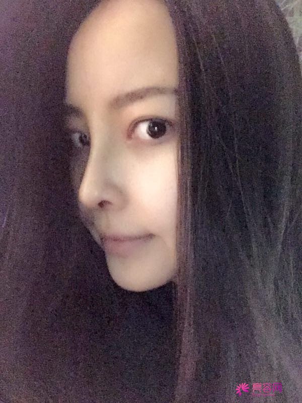 我来和大家分享我的隆鼻日记了,我自己恢复得不错,所以放心大胆的将自己的鼻子交给医院啦~