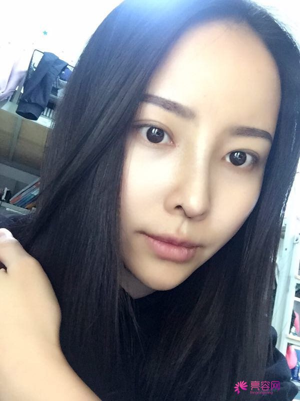 我来和大家分享我的隆鼻日记了,我自己恢复得不错,所以放心大胆的将自己的鼻子交给医院啦~