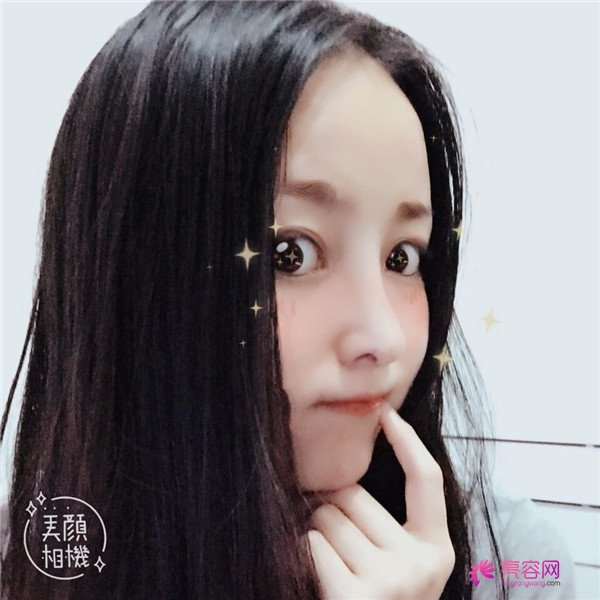 我来和大家分享我的隆鼻日记了,我自己恢复得不错,所以放心大胆的将自己的鼻子交给医院啦~