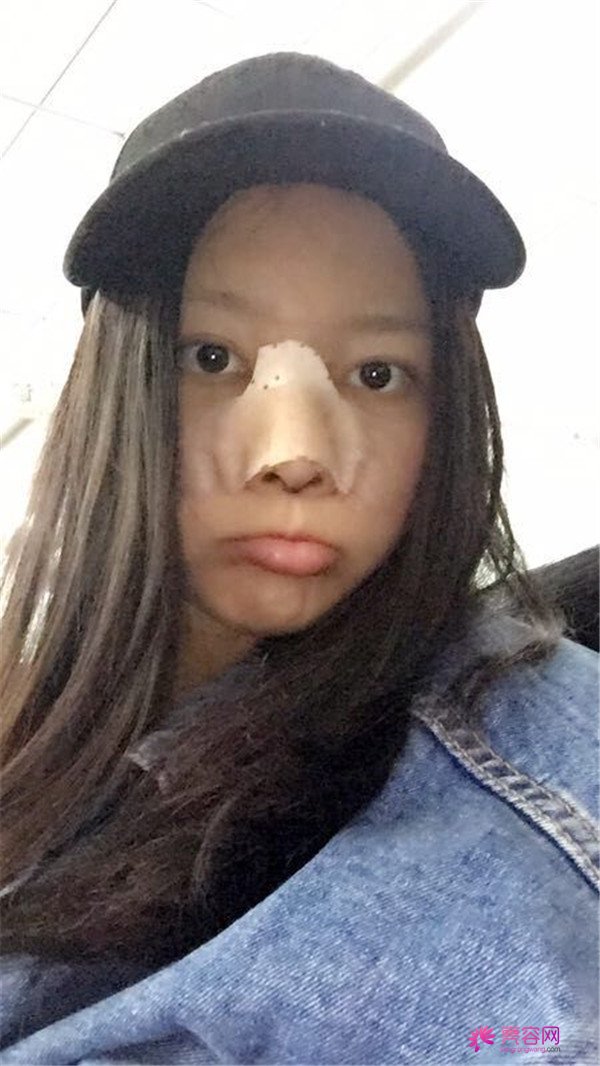 我来和大家分享我的隆鼻日记了,我自己恢复得不错,所以放心大胆的将自己的鼻子交给医院啦~